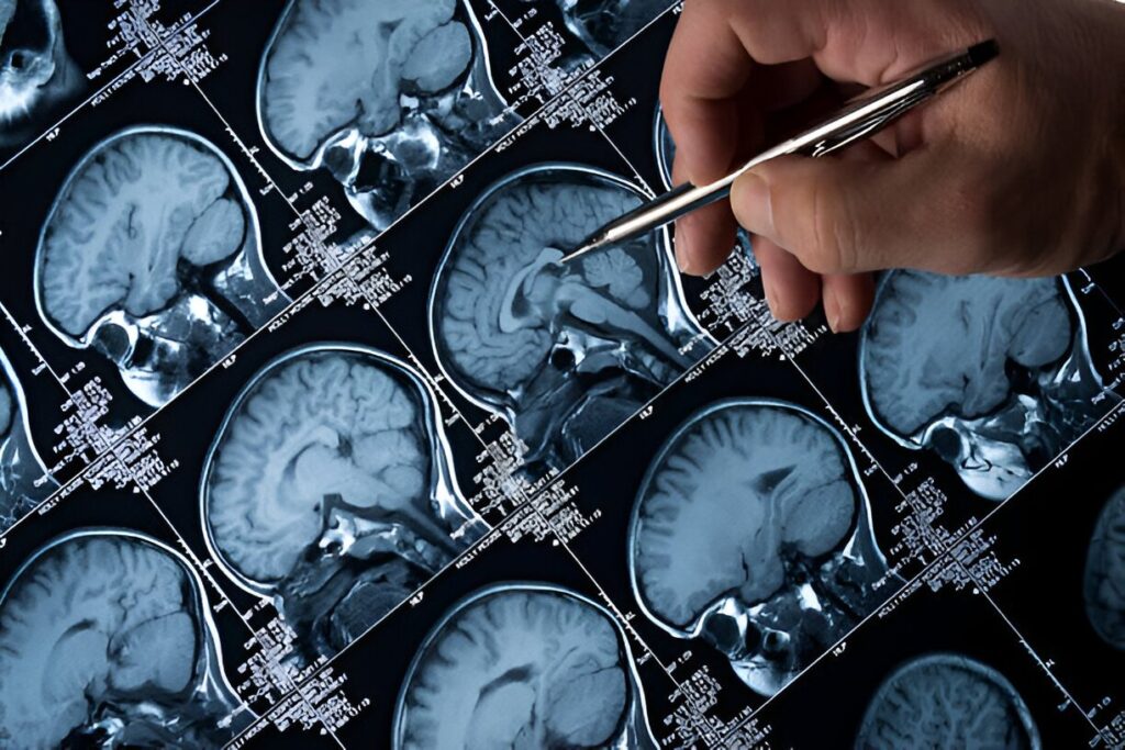 Alzheimer's Symptoms: Human Brain Testing