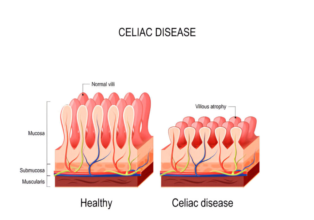 Prevention of Celiac Disease